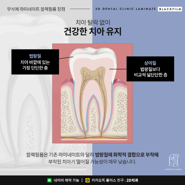 치아 삭제 없는 앞니 무삭제 라미네이트 <블랙필름> 관련 이미지 4