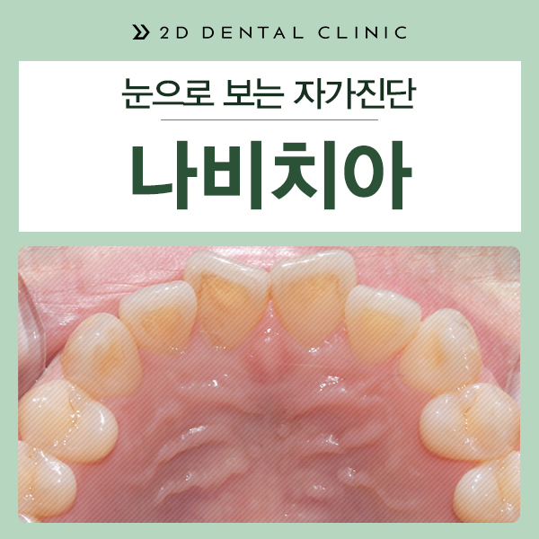 나비치아 교정 케이스 전후비교, 교정전문 2D치과 관련 이미지 2