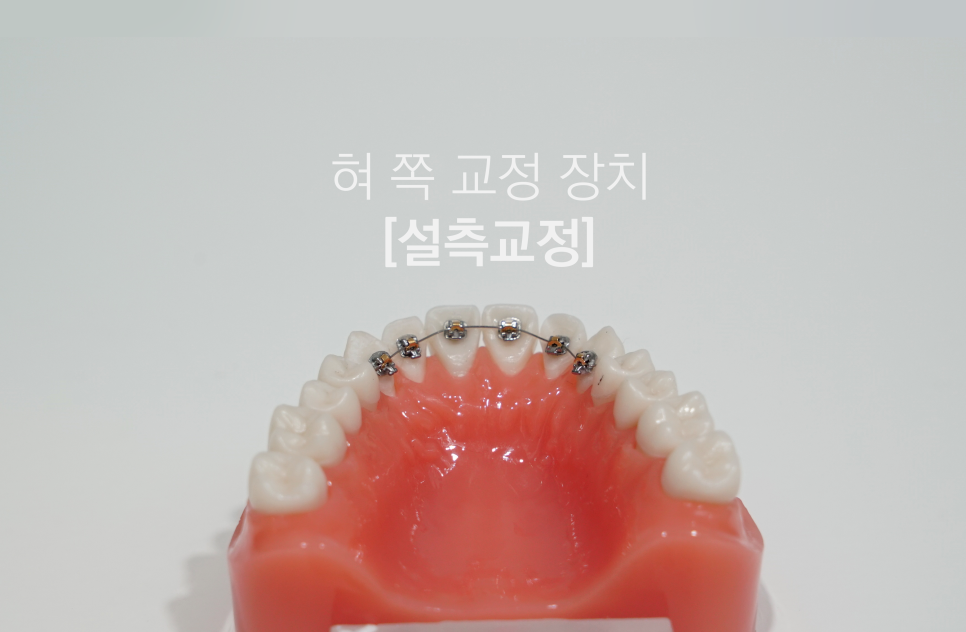 2D(투디)치과!치아교정!클리피씨교정,순측 교정?설측교정? 관련 이미지 3