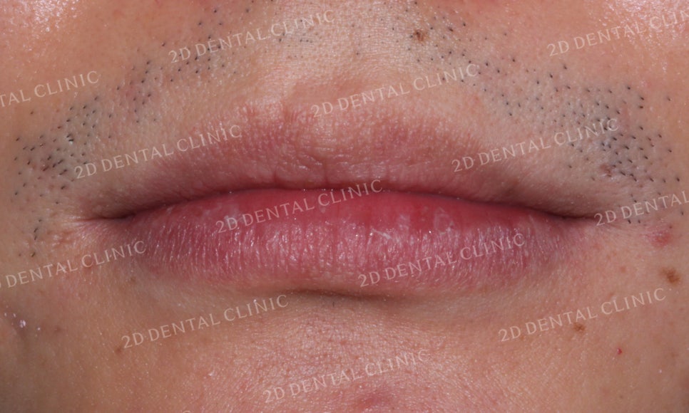 [2D교정] 나비치아교정을 2D교정 장치로 빠르게 완성하기! by.2D치과(투디치과) 관련 이미지 2