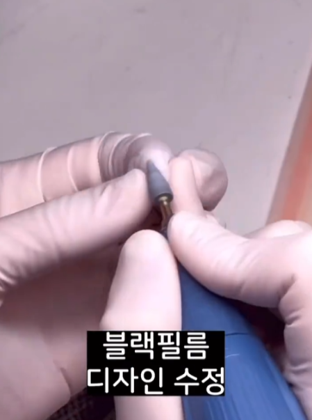 토끼 앞니라미네이트 치아삭제 없이 무삭제라미네이트 블랙필름으로 개선 관련 이미지 3