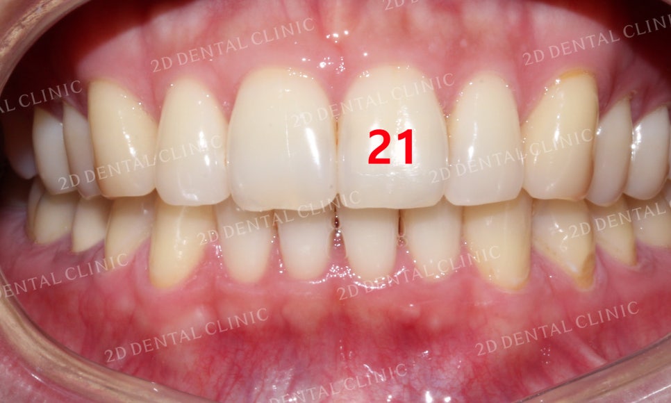 틀어진 앞니를 전체 교정으로 바르게! by.투디치과(2D치과) 관련 이미지 14