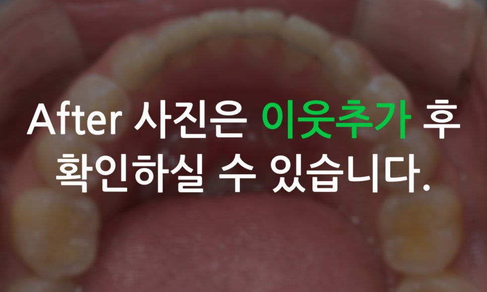 앞니돌출 급속교정 Case feat. 2D교정 관련 이미지 9