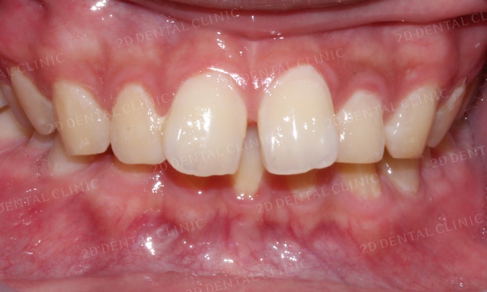 [앞니교정] 벌어진 앞니, 부분교정으로 앞니교정하기! by.2D치과(투디치과) 관련 이미지 5