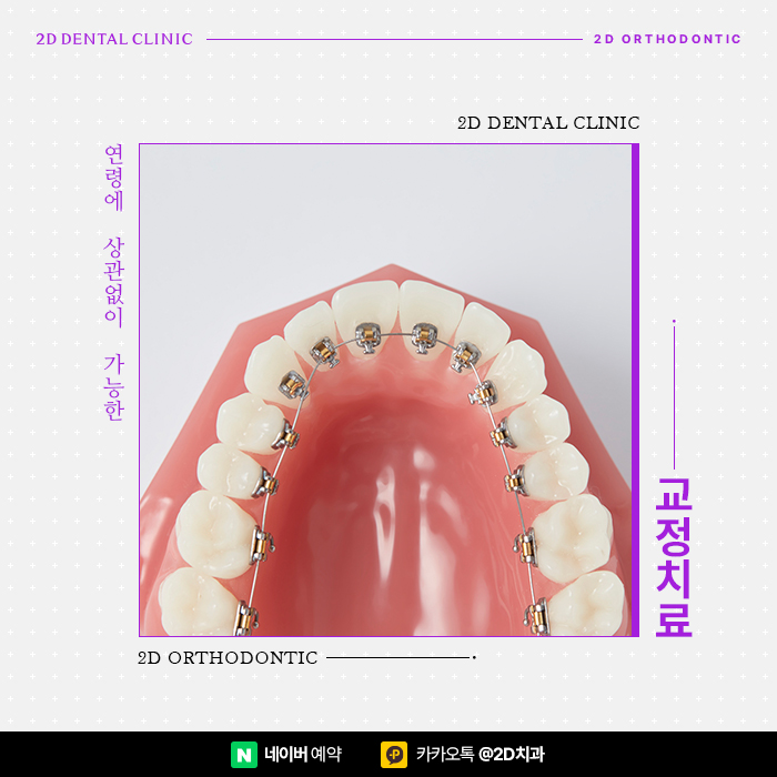 늦지 않은 40대치아교정, 강남 심미성, 기능성 높이는 치아교정 관련 이미지 1