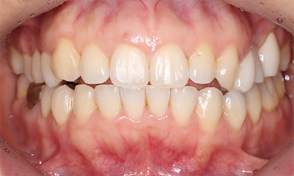 앞니틀어짐 부분교정 완성 후기 관련 이미지 8