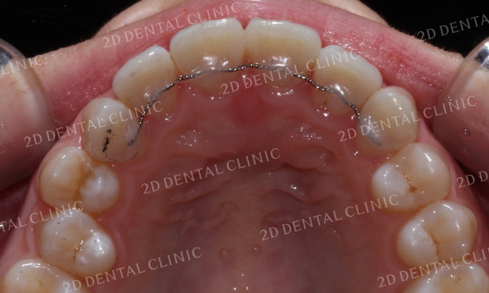 [투디교정] 덧니교정, 앞니교정으로 치열을 고르게! by.투디치과(2D치과) 관련 이미지 16