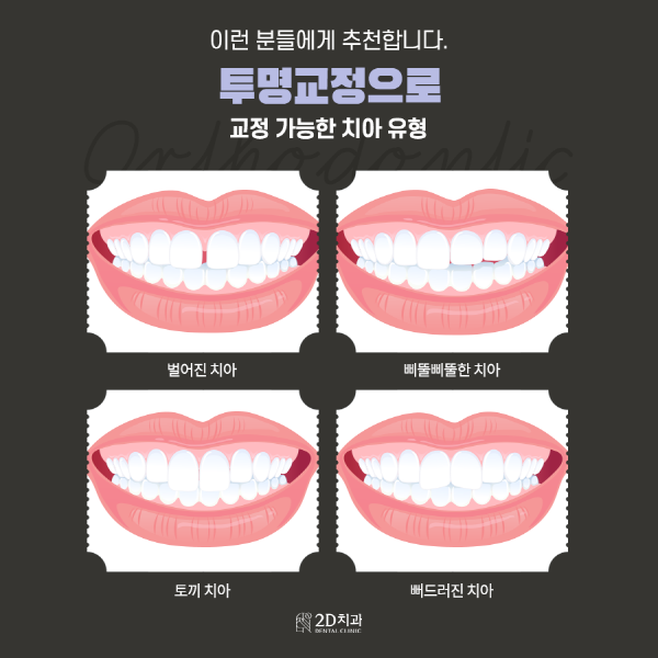 교정과 미백을 동시에! 1DAY 치료 가능한 <투미교정> 관련 이미지 2