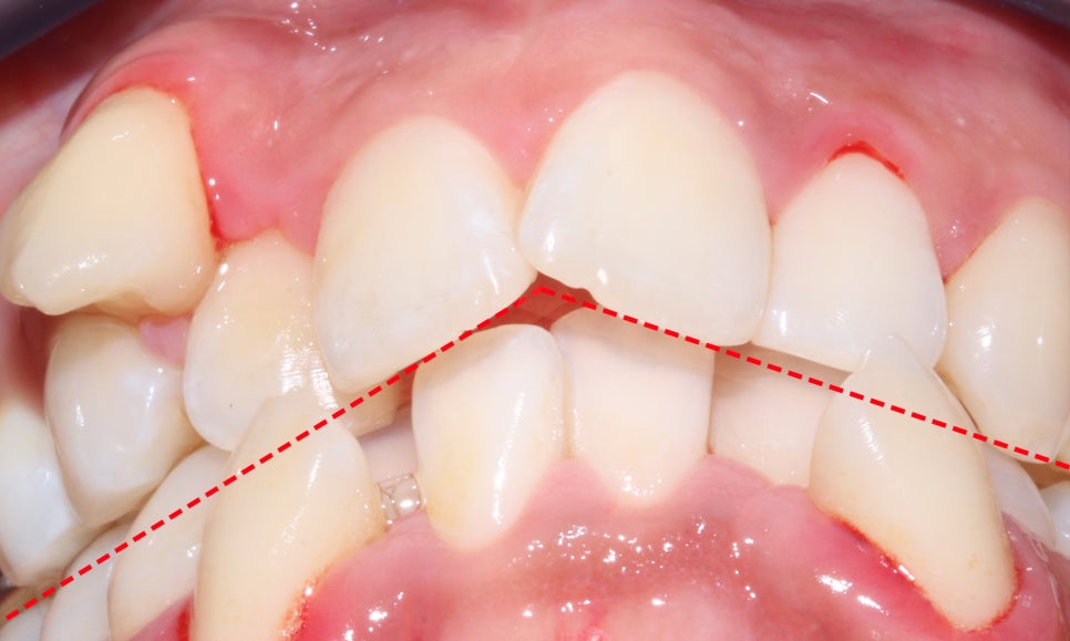 crowding 송곳니덧니 세라믹교정 방법 관련 이미지 3