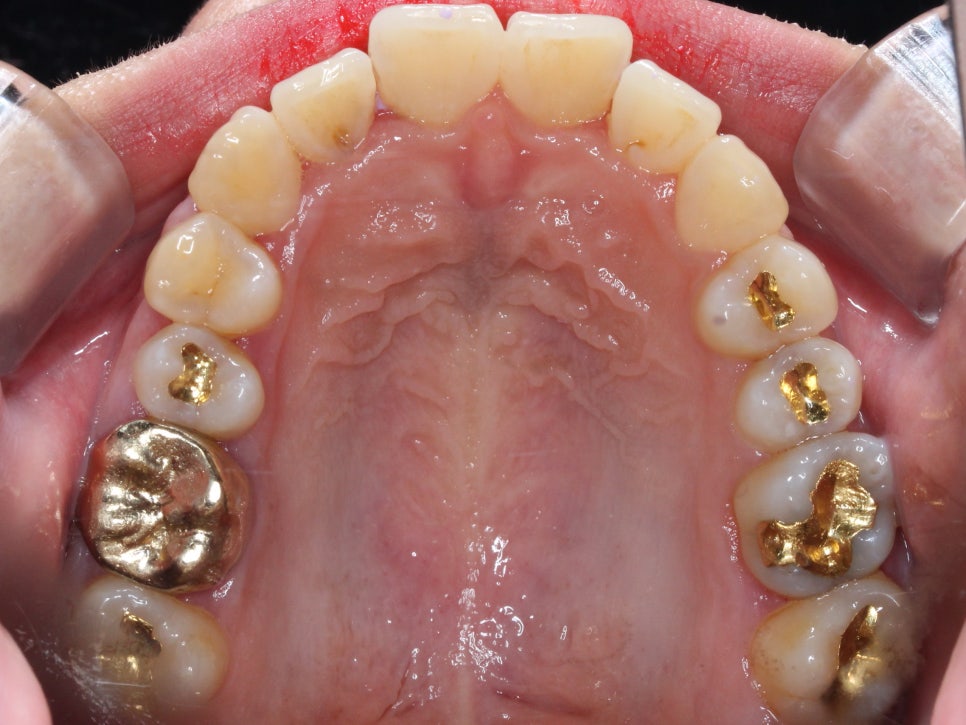 덧니 투명교정 8개월 치료 사례 관련 이미지 10