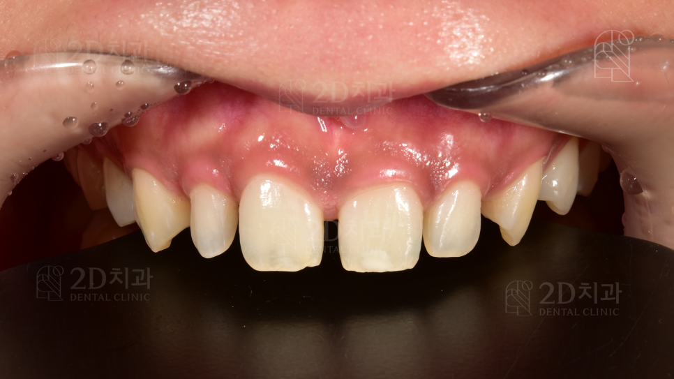 왜소치 라미네이트  신논현역 2D치과 관련 이미지 2