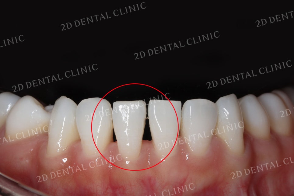 치아틈새를 완벽하게 메꾸자! 블랙트라이앵글 쎄라필름으로 완전 삭제! by.투디치과(2D치과) 관련 이미지 13