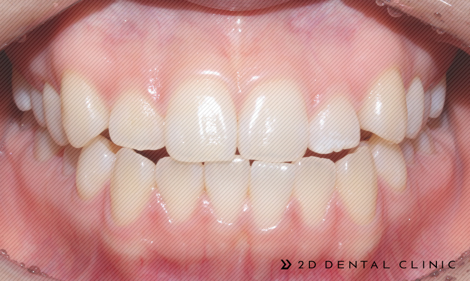 절단교합 교정 케이스 전후비교, 교정전문 2D치과 관련 이미지 6