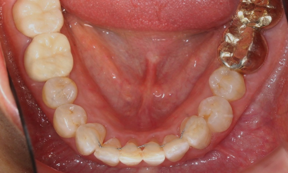 2D치과 2D부분교정으로 아랫니만 빠르게! 관련 이미지 10