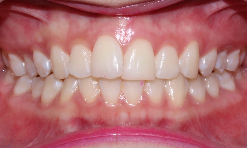 반포치과 뻐드렁니교정 방법은? 관련 이미지 4