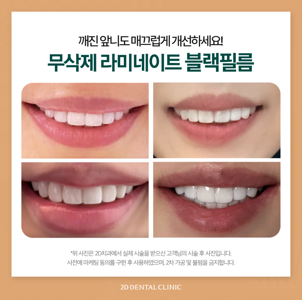 무삭제라미네이트후기 치아살짝깨짐 그대로 두어도 될까요? 관련 이미지 6