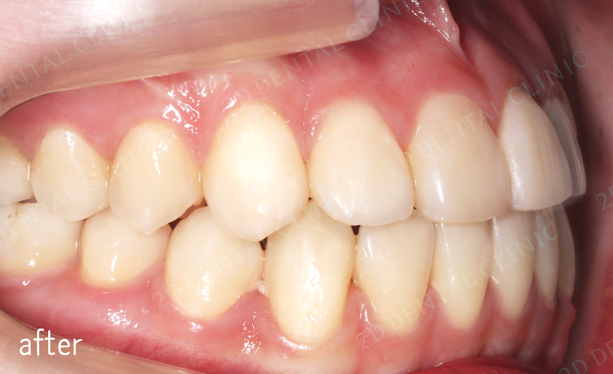 우디의 교정일기ㅣ덧니 치아교정 후기 (feat.부정교합) 관련 이미지 7