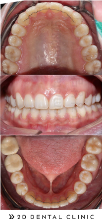 돌출입 유형 및 증상, 치과 내원 전 자가진단! 관련 이미지 9