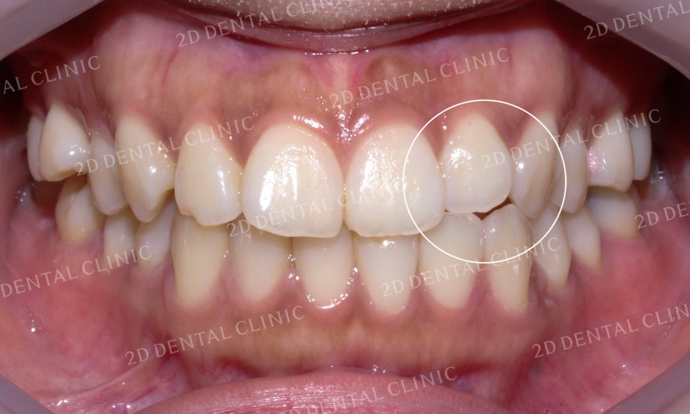 토끼앞니, 튀어나온 앞니 부분교정 후기! by.투디치과(2D치과) 관련 이미지 12