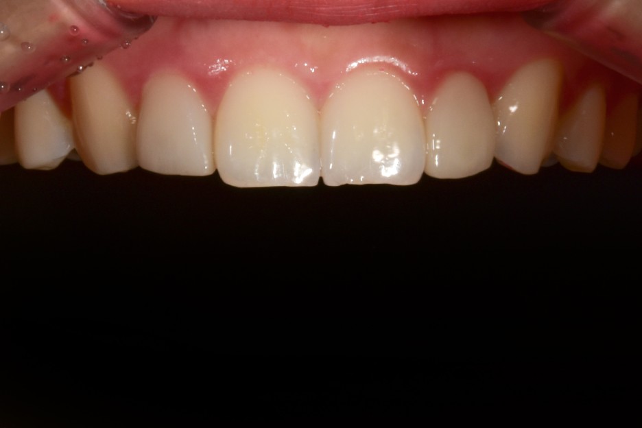 [투디치과] 블랙필름(비스포크) 치료의 다양한 사례 관련 이미지 24