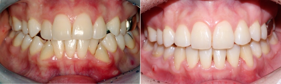 덧니만 부분교정으로 교정 할 수 있나요? 관련 이미지 5