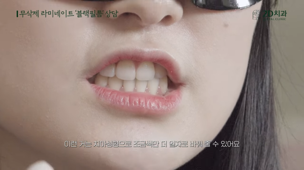 [블랙필름 상담받고 왔어요] #1 큰 앞니 작게 만들 수 있나요? 관련 이미지 11