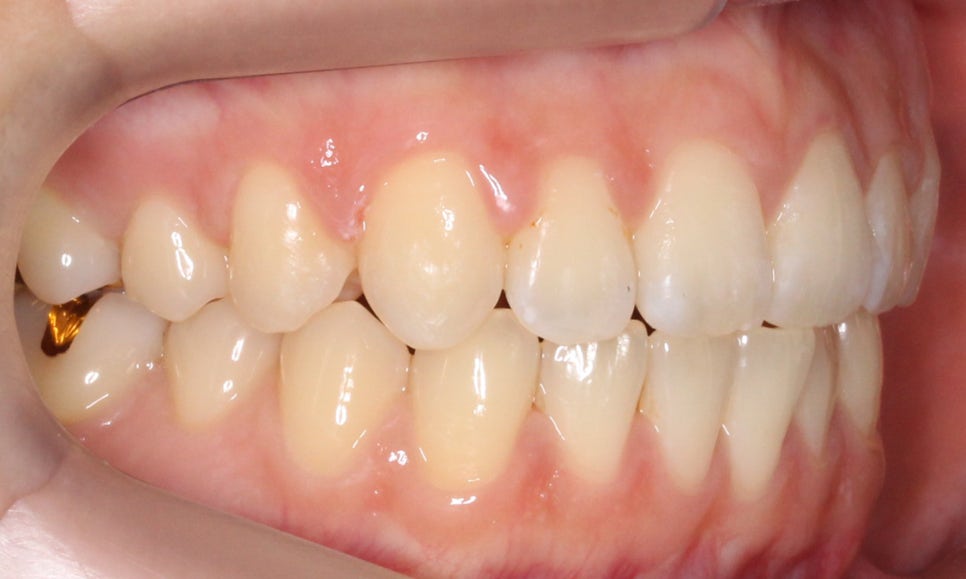 나비앞니 세라믹교정 case 관련 이미지 11