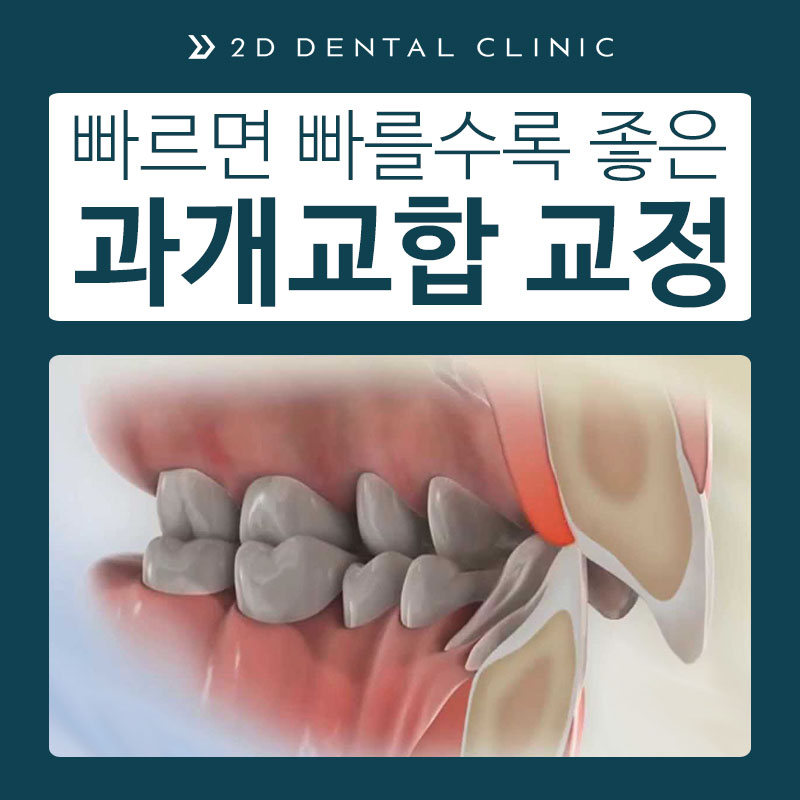과개교합 케이스도 2D치과에서 해결! 관련 이미지 2
