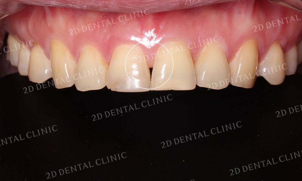 누렇고 손상된 치아를 밝고 가지런하게! by. 투디치과(2D치과)_블링스 시술후기 관련 이미지 11