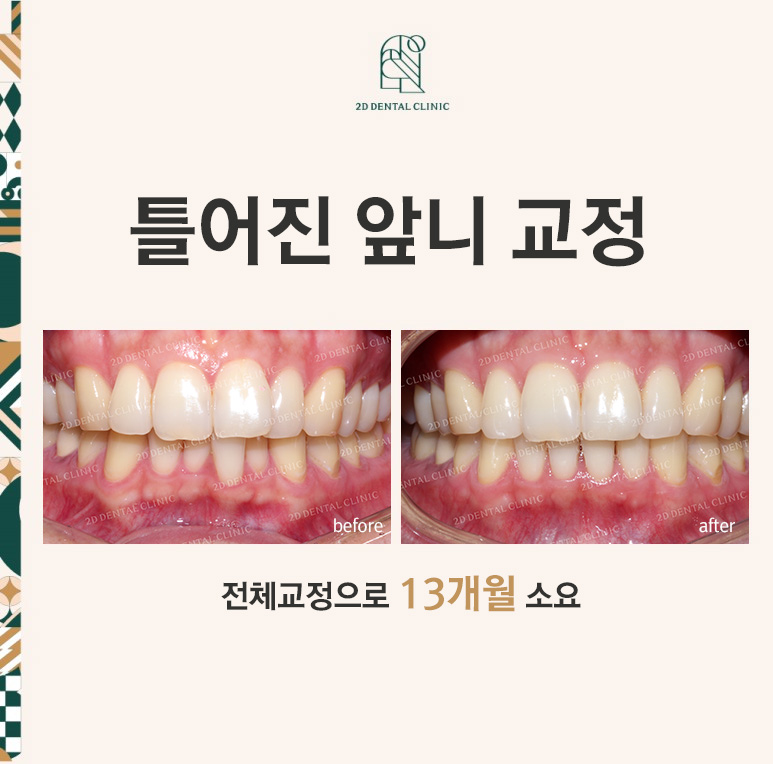 틀어진 앞니를 전체 교정으로 바르게! by.투디치과(2D치과) 관련 이미지 1