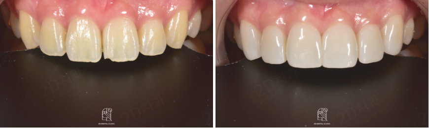 앞니깨짐 라미네이트로 자연스럽게! 관련 이미지 8