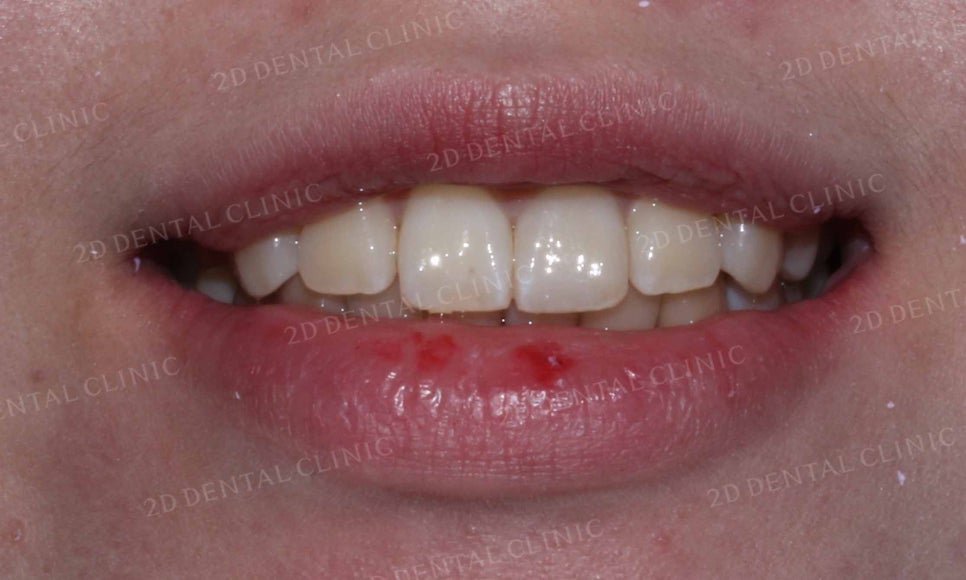 강남역 치과에서 앞니부분 설측 2D(투디)교정으로 토끼앞니 탈출한 후기 관련 이미지 11