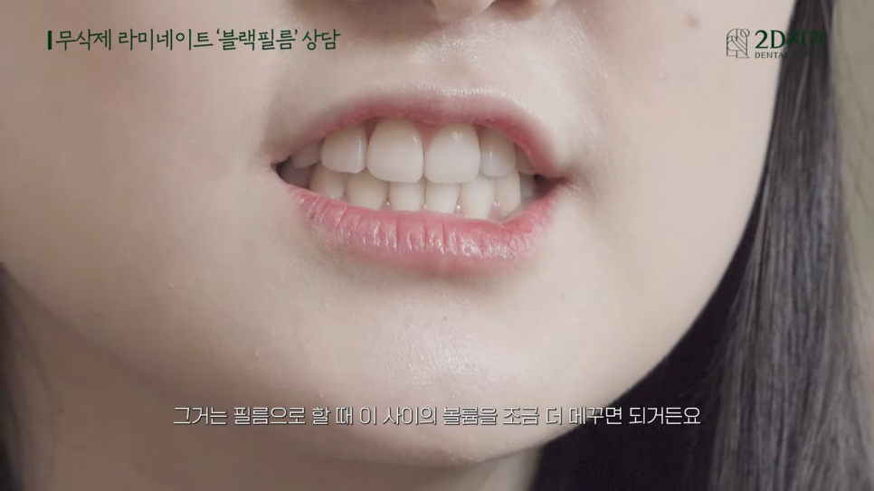 [블랙필름 상담받고 왔어요] #1 큰 앞니 작게 만들 수 있나요? 관련 이미지 19