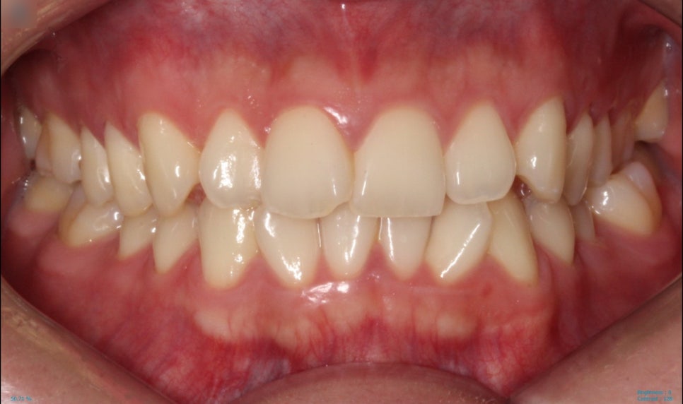 부분교정으로 삐뚤어진 앞니 예뻐지는 방법 관련 이미지 5