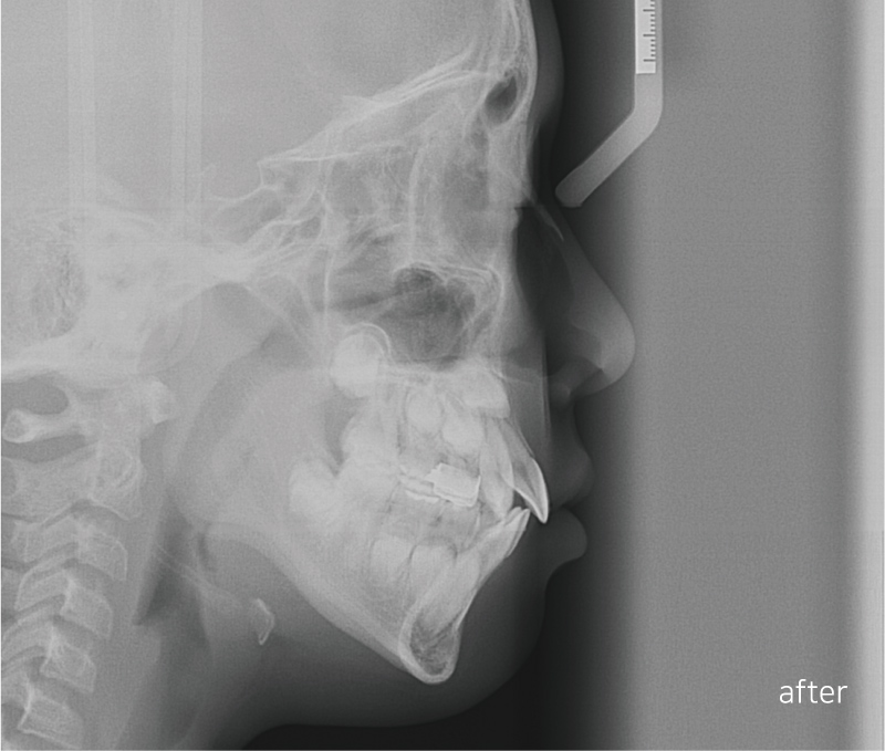어린이 반대교합 덧니 교정으로 교정 끝! by. 투디치과(2D치과) 관련 이미지 13