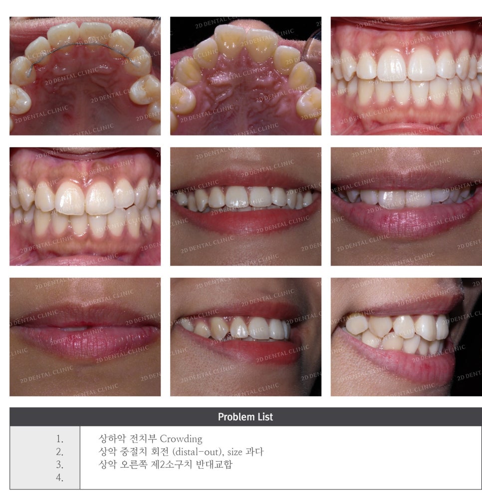 토끼앞니, 튀어나온 앞니 부분교정 후기! by.투디치과(2D치과) 관련 이미지 5