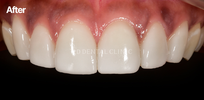 앞니치아마모증 무삭제라미네이트 블랙필름으로 치아고민해결 관련 이미지 3