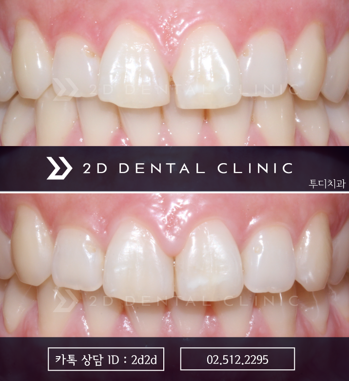앞니 부분교정, 나의 경우에도 가능할까? 전후 사진 비교 관련 이미지 7