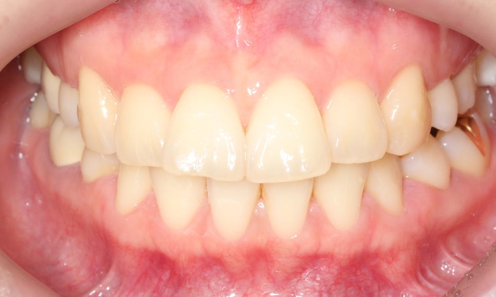 대치동치과 입툭튀 집어넣는 교정 관련 이미지 1