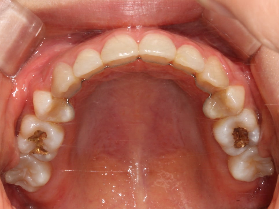 돌출입 탈출기! 덧니 교정도 문제없어! by.투디치과(2D치과) 관련 이미지 12