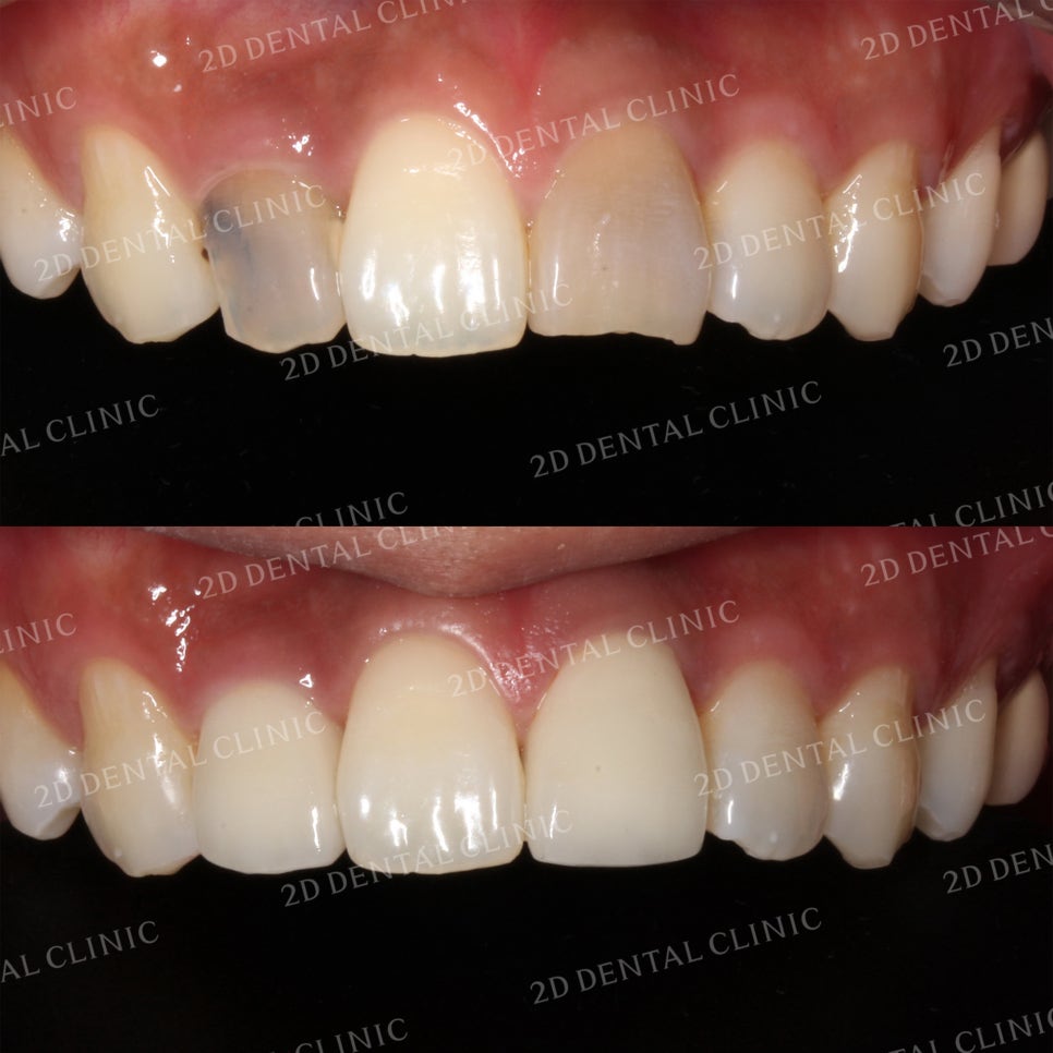 치아변색, 까맣게 변한 변색치를 블링스(Blinx)로 수복하기! by. 투디치과(2D치과) 관련 이미지 1