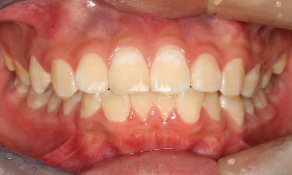 라미네이트에서 중요한 것은..심미적 요소, 블링스 관련 이미지 7