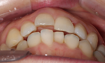 앞니틀어짐 부분교정 완성 후기 관련 이미지 2