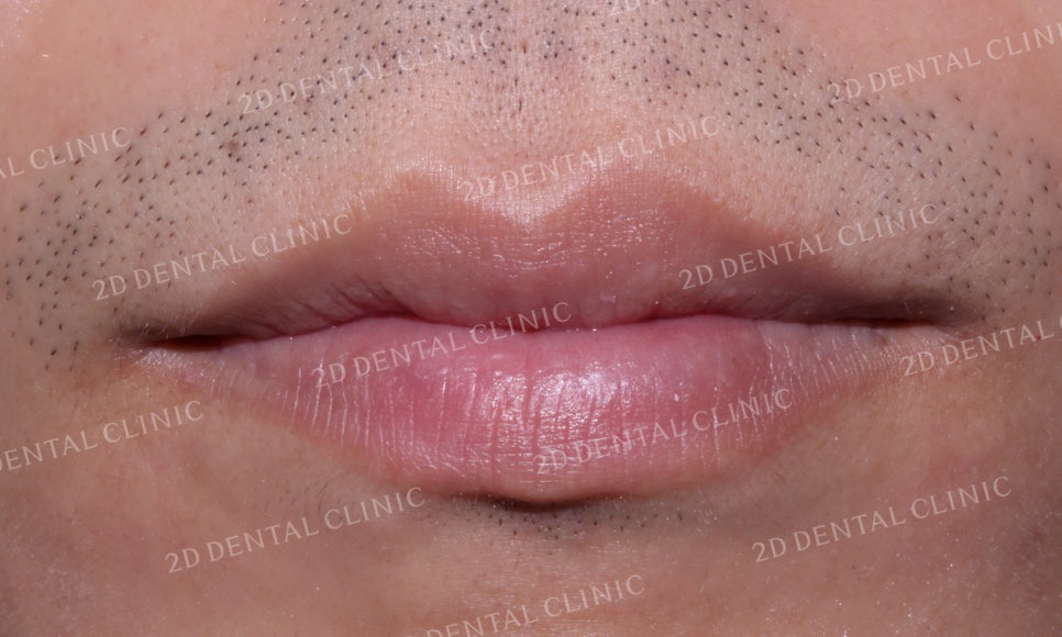 틀어진 앞니를 전체 교정으로 바르게! by.투디치과(2D치과) 관련 이미지 2