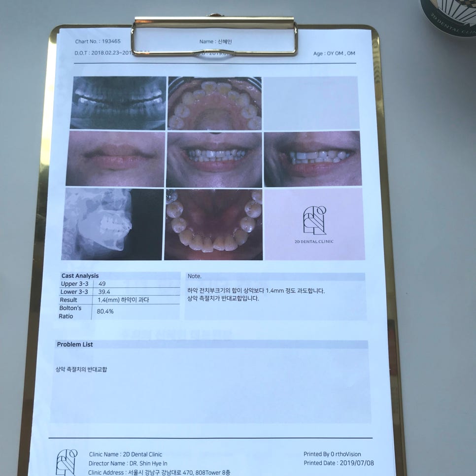 2D치과(투디치과) 교정일기ㅣ앞니덧니,반대교합 치아교정 완료!(ft.투디교정 전체교정) 관련 이미지 4
