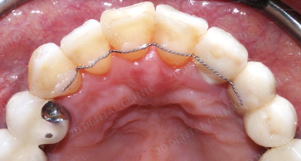 2D치과(투디치과) 교정일기 ㅣ 잇몸질환 예방되는 치아교정(feat.어머님교정) 관련 이미지 3