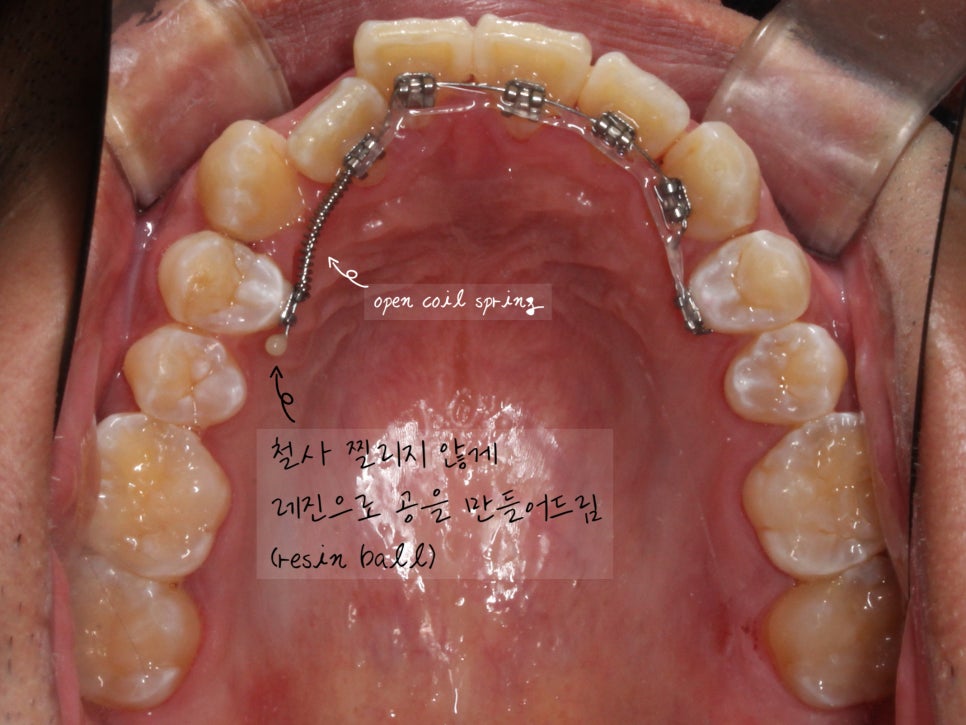 앞니 덧니 고민, 부분 설측 교정으로 해결한 사례 관련 이미지 8