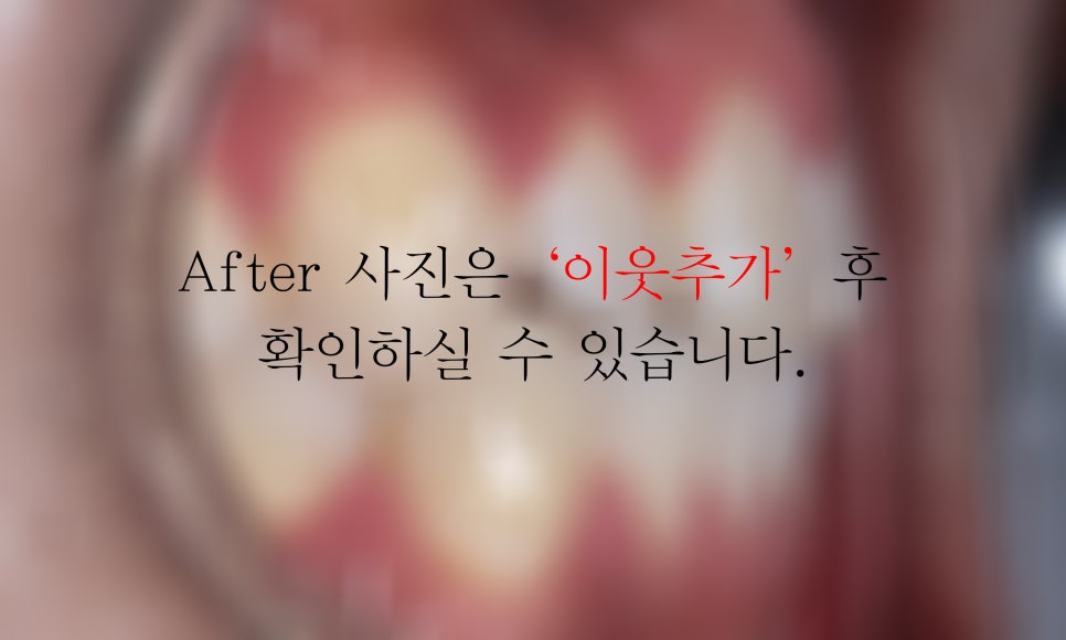 아랫니 부분교정 2D교정(설측교정)으로 가능할까? 관련 이미지 7
