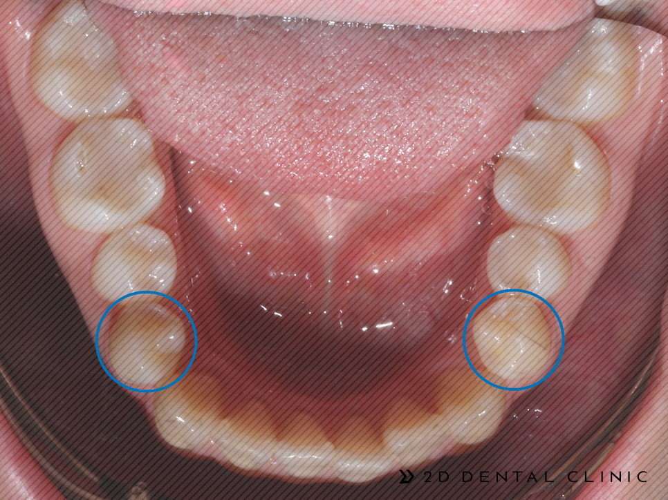 절단교합 교정 케이스 전후비교, 교정전문 2D치과 관련 이미지 10