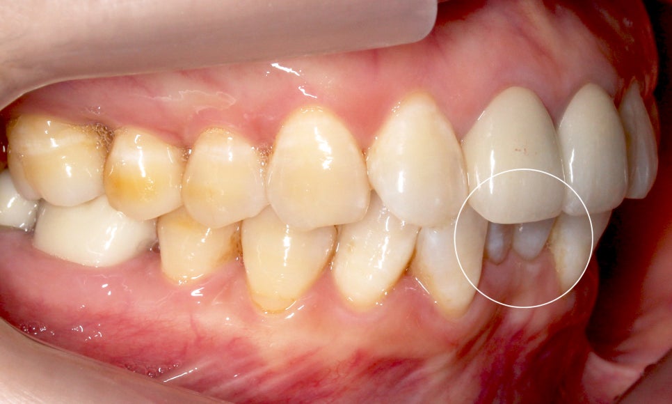 2D교정으로 아랫니 부분교정 빠르게 완성하기! 관련 이미지 3